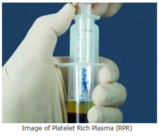Image of Platelet Rich Plasma (RPR)