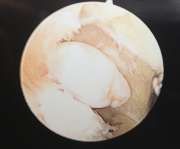 Picture of Ankle Cartilage Damage